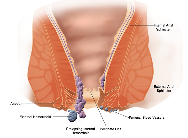 Hemorrhoids diagram